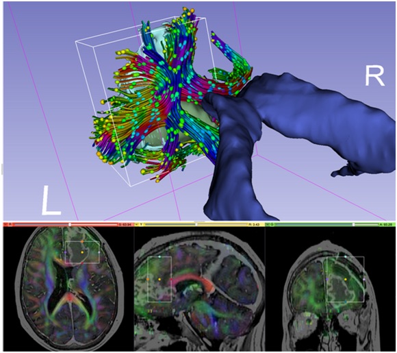 3D Slicer diffusion MRI visualization